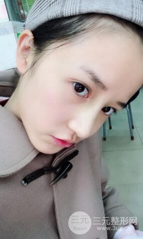 柏麗李勁良假體隆鼻案例果分享！小巧精致又立體~