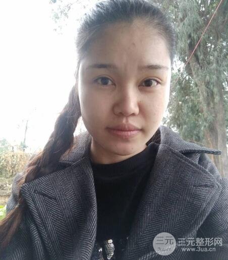 鼻頭縮小術(shù)過程圖，鼻頭縮小恢復(fù)日記