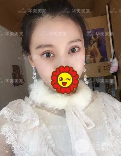 昆明華美楊繼紅全切雙眼皮怎么樣？真實案例圖片分享~