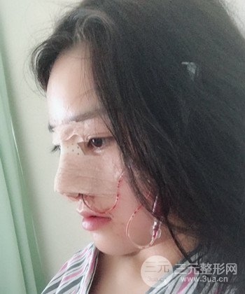 達拉斯綜合隆鼻后對比照片，顏值提高不是夢