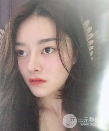 達拉斯綜合隆鼻后對比照片，顏值提高不是夢