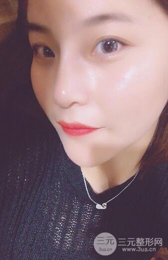 隆鼻鼻翼縮小全過程和術(shù)后照片分享，隨意揉捏很OK