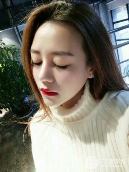 【高強(qiáng)度聚焦超聲面b提升術(shù)后照片】原來(lái)我的青春并沒(méi)有走遠(yuǎn)~