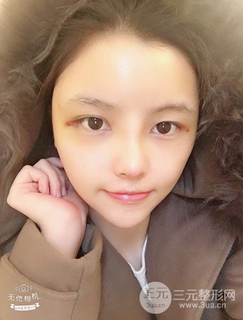 全臉自體脂肪填充+隆鼻整形果永.久保持、丑小鴨變天鵝不是夢