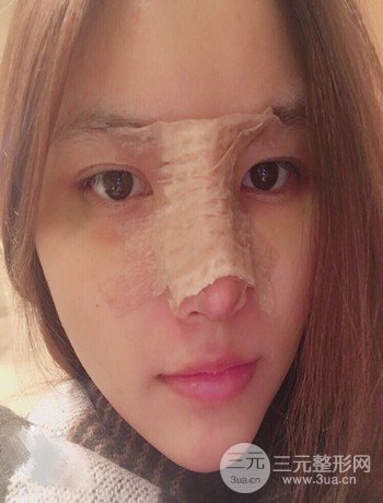 全臉自體脂肪填充+隆鼻整形果永.久保持、丑小鴨變天鵝不是夢