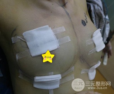 自體脂肪隆胸術(shù)后恢復(fù)過程分享|成功落實變大胸的愿望