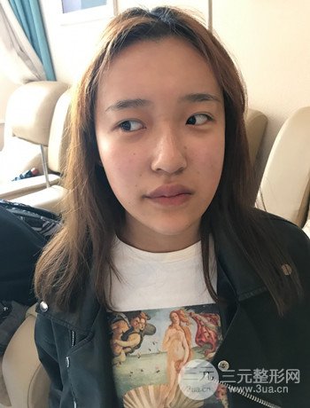 上海面部脂肪填充一個月果超明X、妥妥減齡十歲！