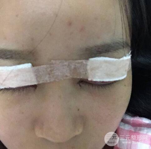 芭比電雙眼皮多項整形術(shù)后分享，雙眼皮拯救死魚眼！