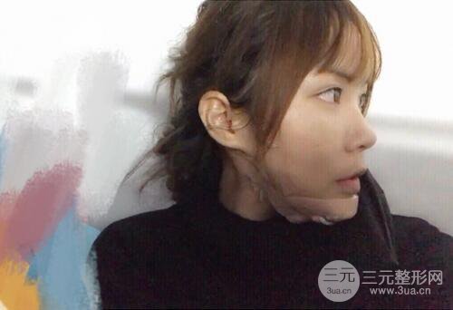 自體脂肪填充全臉基本換臉，改臉型不只是磨骨才能做到！