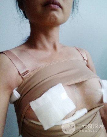 上海假體隆胸真人案例，罩杯從A-到C不是夢