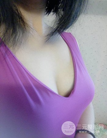 上海假體隆胸真人案例，罩杯從A-到C不是夢