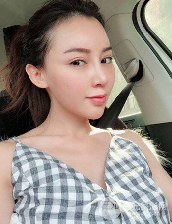 上海隆鼻失敗手術(shù)修復(fù)果超乎想象、前后對比照片分享