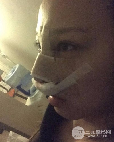 武漢美侖陳遠(yuǎn)海假體隆鼻案例，恢復(fù)過(guò)程分享~