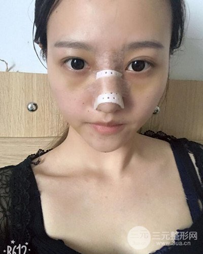 武漢美侖陳遠(yuǎn)海假體隆鼻案例，恢復(fù)過(guò)程分享~