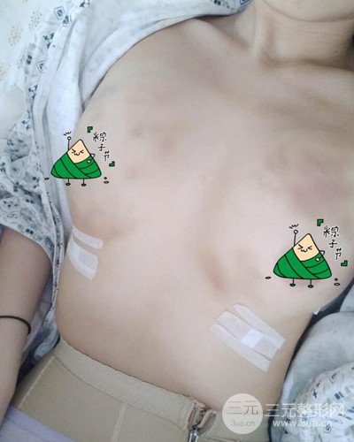 武漢同濟(jì)自體脂肪隆胸案例，恢復(fù)過(guò)程前后對(duì)比圖分享~