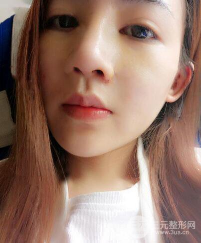 耳軟骨隆鼻全過(guò)程及術(shù)后果分享，親身體驗(yàn)~