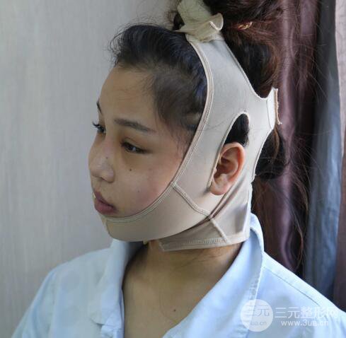 【下頜角+顴骨+下巴】全臉磨骨整形，術(shù)后的我人生開掛了！