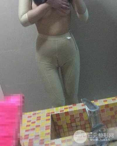廣州韓妃大腿吸脂案例，恢復(fù)過程前后對比圖片分享~