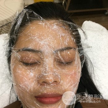 廣州激光祛雀斑果不反彈、恢復過程圖片分享