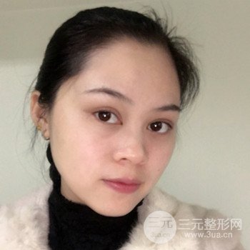 廣州激光祛雀斑果不反彈、恢復過程圖片分享