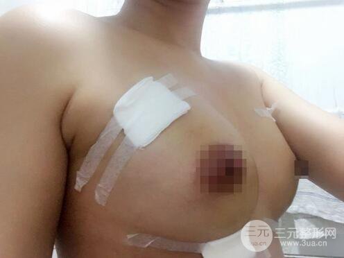 自體脂肪納米豐胸三個月術(shù)后果展示（附圖）