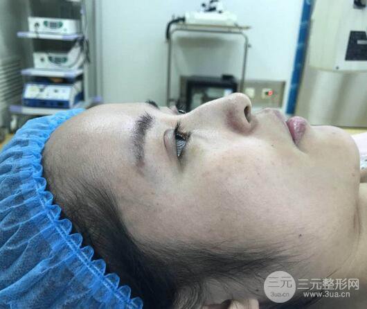 硅膠隆鼻術(shù)前術(shù)后對比照片分享，走上顏值頂峰