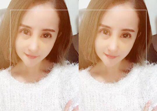 硅膠隆鼻術(shù)前術(shù)后對比照片分享，走上顏值頂峰