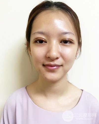 深圳蒳美邇黃海彬雙眼皮案例恢復過程對比圖分享~