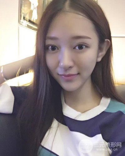 深圳蒳美邇黃海彬雙眼皮案例恢復過程對比圖分享~