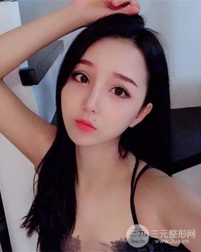 深圳蒳美邇朱燦醫(yī)生眼隆鼻整形案例分享，附上前后對比照~