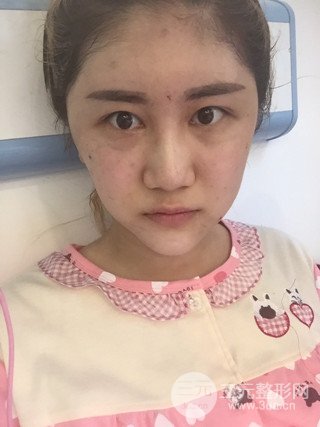 深圳臻希美詳細部自體脂肪填充果對比超明X