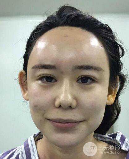 全臉自體脂肪填充，填充不飽滿還可以瘦臉_真人案例