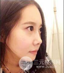 顴骨磨骨改臉型過程和恢復步驟照片（圖）