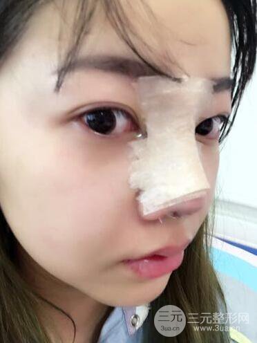 西安西京醫(yī)院整形科潘勇隆鼻整形案例以及前后對(duì)比圖展示~