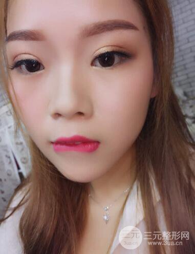 深圳朱武根雙眼皮案例術(shù)后恢復(fù)果記錄