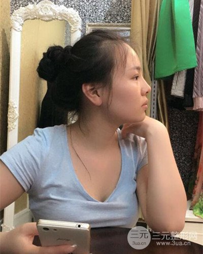 蘇州美萊尹飛隆鼻整形案例，前后恢復(fù)圖分享~