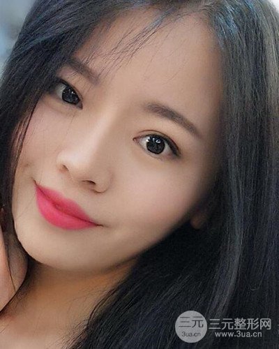 蘇州美萊尹飛隆鼻整形案例，前后恢復(fù)圖分享~