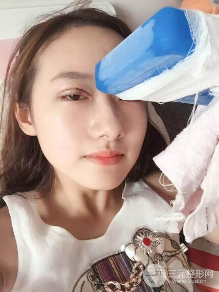 西安西美張麗雙眼皮案例圖片分享