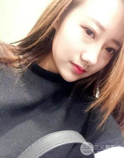 西安西美張麗雙眼皮案例圖片分享