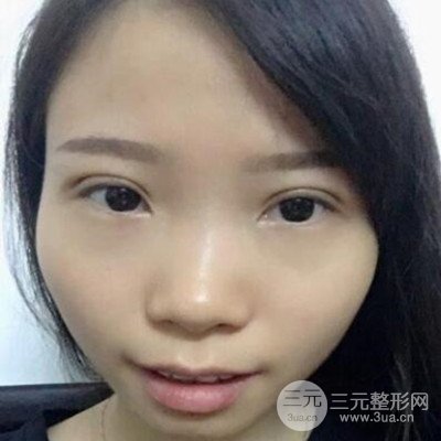 張永義醫(yī)生全切雙眼皮案例前后對(duì)比圖