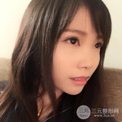 張永義醫(yī)生全切雙眼皮案例前后對(duì)比圖