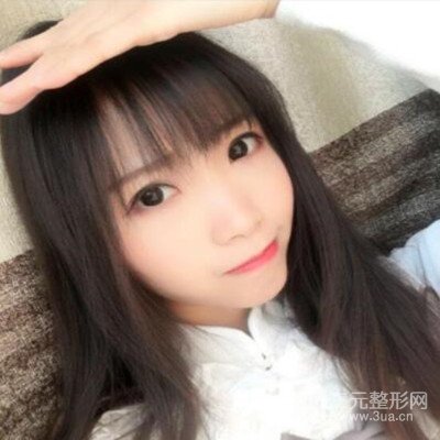 張永義醫(yī)生全切雙眼皮案例前后對(duì)比圖