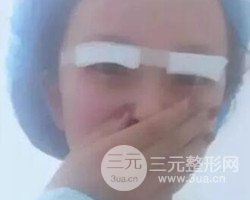 南京鼓樓譚謙醫(yī)生切開雙眼皮案例，恢復(fù)圖分享~
