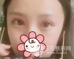 南京鼓樓譚謙醫(yī)生切開雙眼皮案例，恢復(fù)圖分享~