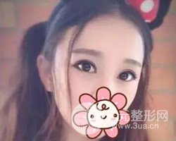 南京鼓樓譚謙醫(yī)生切開雙眼皮案例，恢復(fù)圖分享~