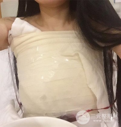 假體隆胸手術恢復記錄，豐滿大胸不是夢