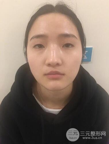 重慶華美何春濤雙眼皮案例圖片恢復(fù)記錄