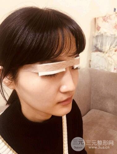 重慶華美何春濤雙眼皮案例圖片恢復(fù)記錄