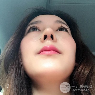 成都華顏黃富偉自體軟骨隆鼻案例前后對(duì)比圖分享