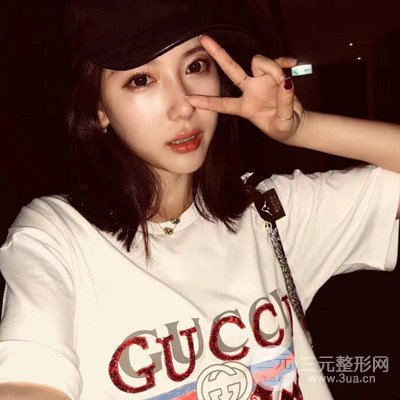 成都華顏黃富偉自體軟骨隆鼻案例前后對(duì)比圖分享